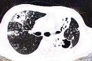CT plic pacienta infikovaného Aspergillus hubkae odhaluje mnohočetné dutiny a tzv. obraz „stromu v rozpuku“ v horních částech plic.